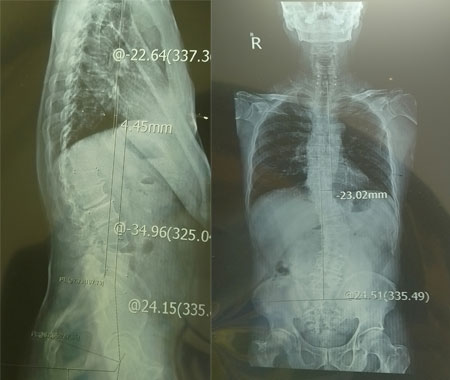 Trị liệu đau lưng